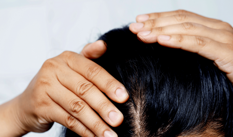 Traitement de la teigne du cuir chevelu