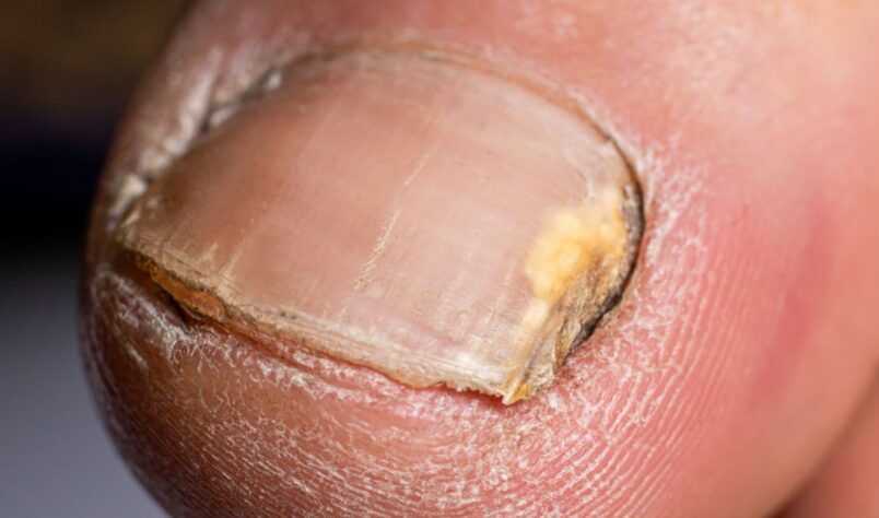 Traitement des dermatomycoses et onychomycoses